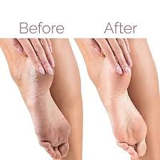 Electric Pedicure Foot File Callus Remover